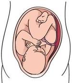Posición de las Caderas del bebé en el vientre materno. 